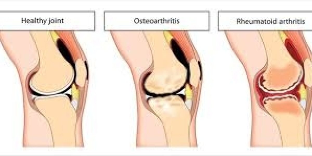 Sciatica vs. Piriformis Syndrome: What Are the Main Differences?