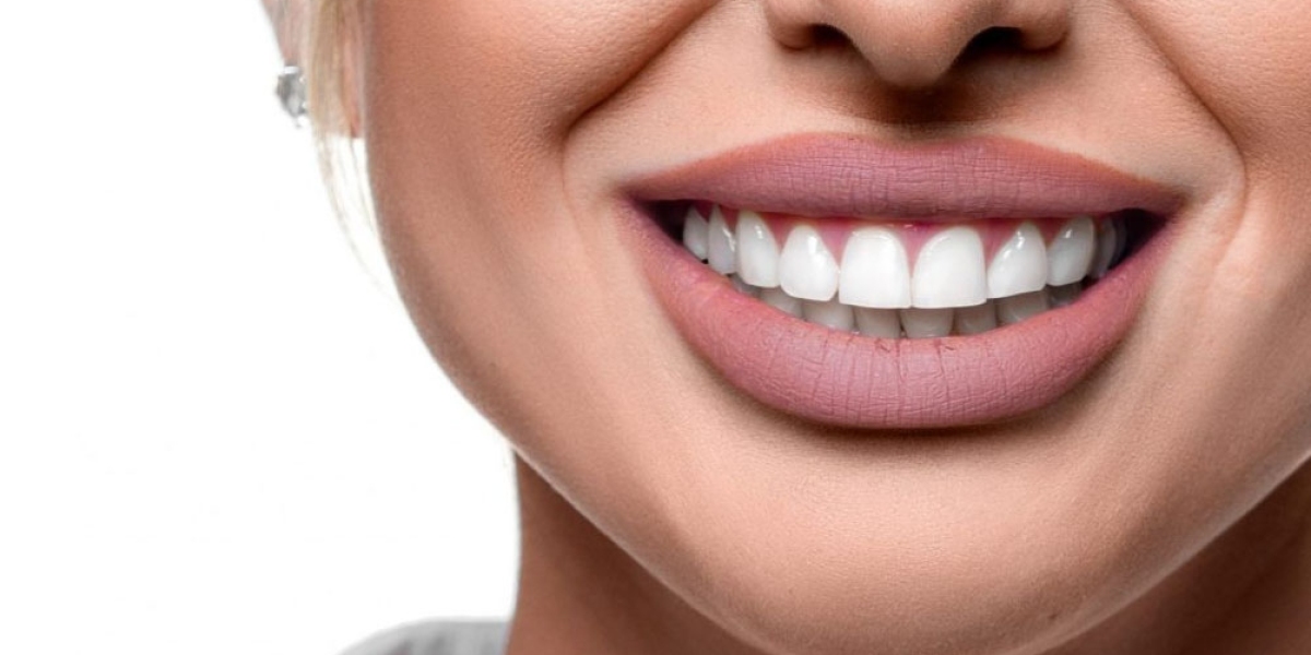 Is Hollywood Smile Dental Clinic the Secret to a Perfect Smile?