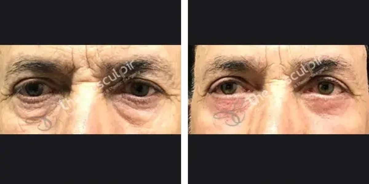 Blepharoplasty Surgery Cost in Delhi – The Aesculpir